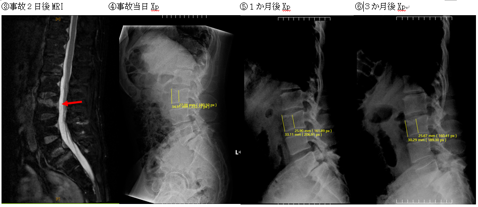 第 三 腰椎 圧迫 骨折